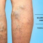 Sclerotherapy For Varicose Veins