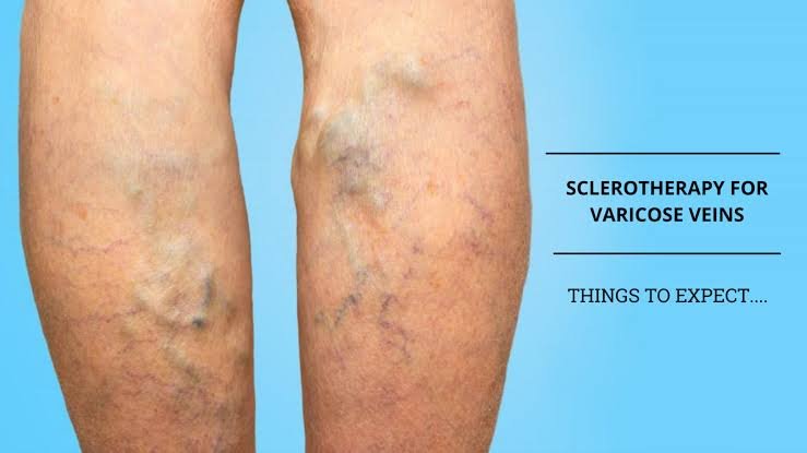 Sclerotherapy For Varicose Veins